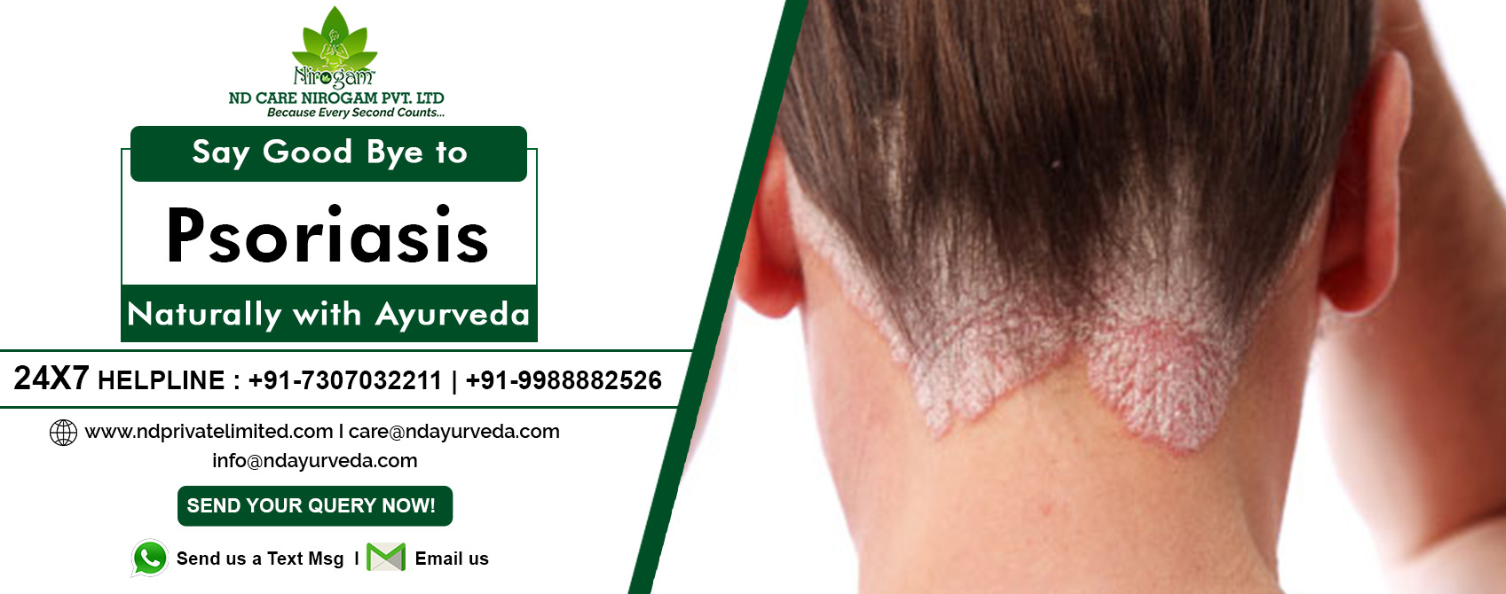 Ayurvedic Psoriasis Treatment